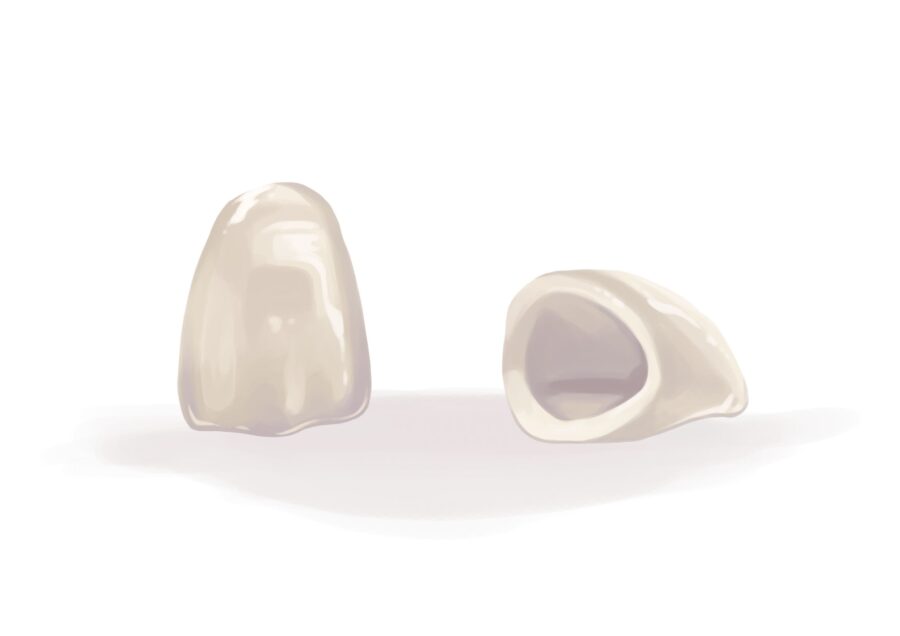 Illustration of CEREC dental crowns that will restore a tooth in one appointment