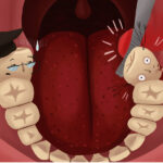 Illustration of wisdom teeth being removed due to overcrowding
