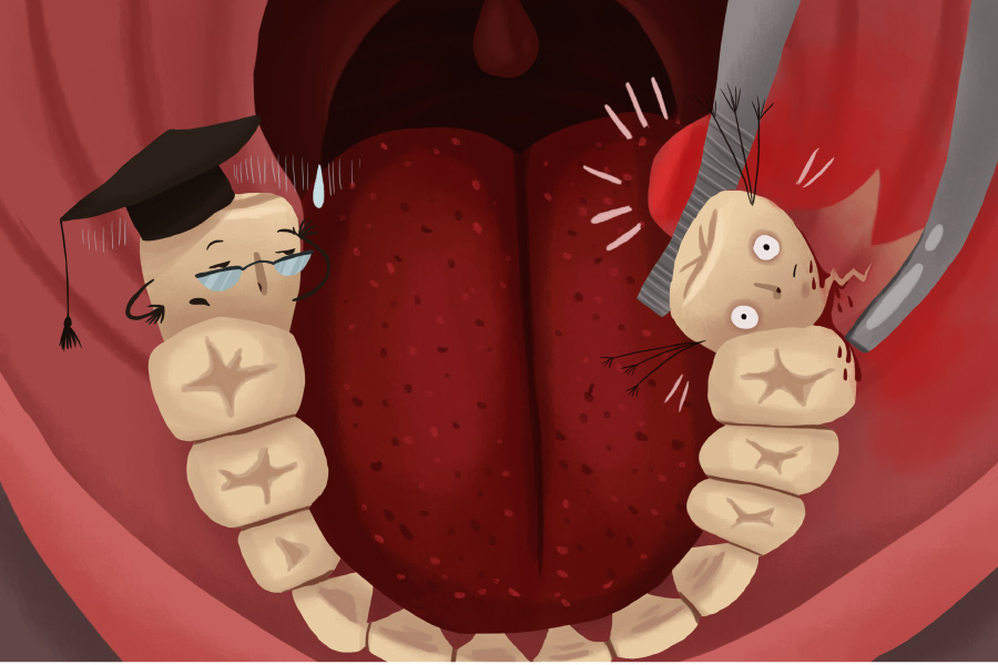 Illustration of wisdom teeth being removed due to overcrowding