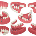 Illustration of different configurations of dental implants