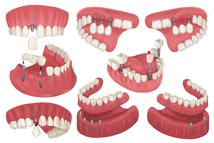 Illustration of different configurations of dental implants