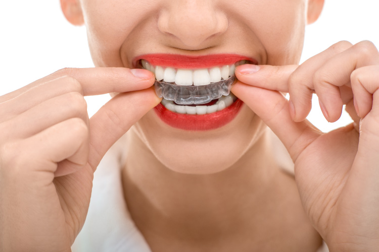 Closeup of a woman with red lipstick smiles as she puts on her clear aligners