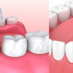 Illustration of a dental crown to cover a tooth next to a dental bridge to replace a missing tooth