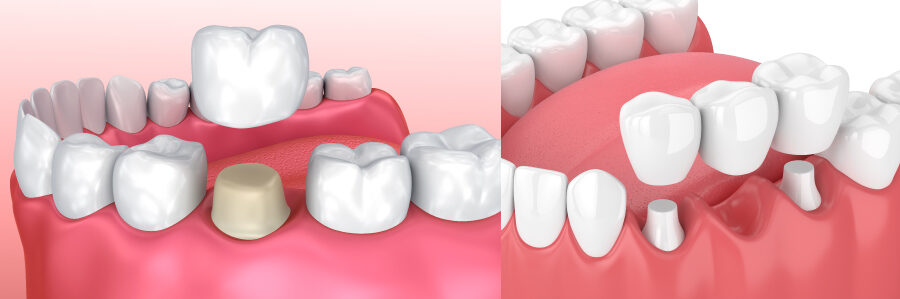 Illustration of a dental crown to cover a tooth next to a dental bridge to replace a missing tooth