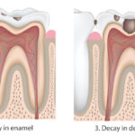 Illustration of the stages of tooth decay to full-blown cavity