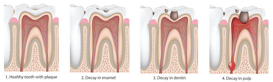 Illustration of the stages of tooth decay to full-blown cavity