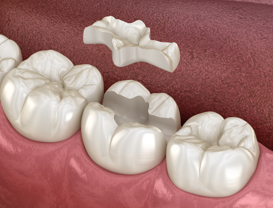 dental bonding, inlay ceramic crown, composite resin