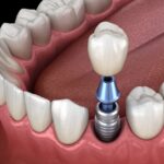 dental implants, tooth replacement, Alma Dental Care, Petaluma CA, osseointegration, jawbone health, dental crowns, dentures