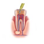 root canal therapy, root canal myths, dental care Petaluma, Dr. Serrano, Alma Dental Care, tooth infection treatment, endodontic treatment