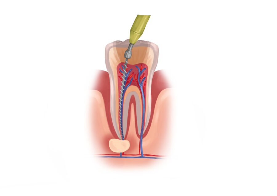 root canal therapy, root canal myths, dental care Petaluma, Dr. Serrano, Alma Dental Care, tooth infection treatment, endodontic treatment