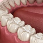dental sealants, cavity prevention, children's dental care, dental health, tooth protection, Dr. Serrano, Alma Dental Care