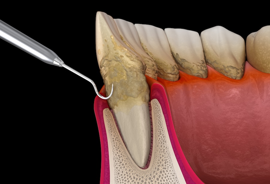 dental plaque and tartar, oral hygiene, Alma Dental Care, Petaluma CA dentist, Dr. Serrano, plaque prevention, tartar treatment, dental health, teeth cleaning, gum disease prevention