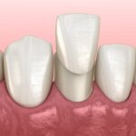 veneers, cosmetic dentistry, teeth whitening, porcelain veneers, Petaluma, Alma Dental Care