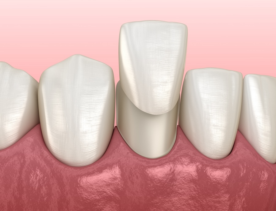 veneers, cosmetic dentistry, teeth whitening, porcelain veneers, Petaluma, Alma Dental Care