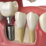 bone health for dental implants, bone grafting, dental implant success, jawbone health, causes of bone loss, maintaining bone health, Alma Dental Care, Petaluma CA, Dr. Serrano, dental implants