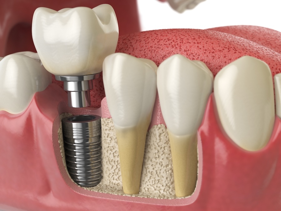 bone health for dental implants, bone grafting, dental implant success, jawbone health, causes of bone loss, maintaining bone health, Alma Dental Care, Petaluma CA, Dr. Serrano, dental implants