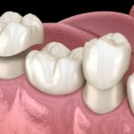 CEREC crowns, same-day crowns, dental crowns in Petaluma, Alma Dental Care, dentist in Petaluma, benefits of CEREC, dental technology, ceramic crowns, same-day dental restoration