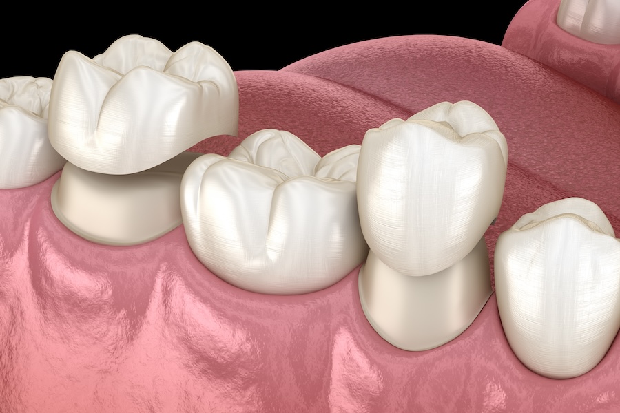 CEREC crowns, same-day crowns, dental crowns in Petaluma, Alma Dental Care, dentist in Petaluma, benefits of CEREC, dental technology, ceramic crowns, same-day dental restoration