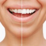 porcelain veneers, veneer myths, cosmetic dental treatments, veneers in Petaluma, Alma Dental Care, dentist in Petaluma, dental veneer benefits, porcelain veneer care