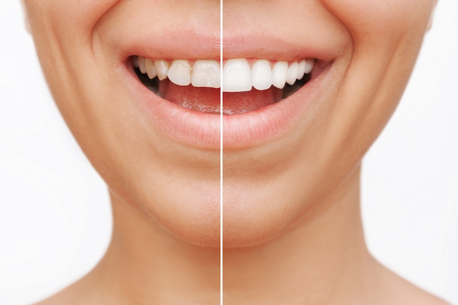 porcelain veneers, veneer myths, cosmetic dental treatments, veneers in Petaluma, Alma Dental Care, dentist in Petaluma, dental veneer benefits, porcelain veneer care