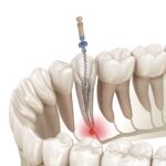 root canal treatment, root canal process, save your tooth, dentist in Petaluma, Alma Dental Care, dental infections, endodontic treatment, dental pain relief, tooth preservation