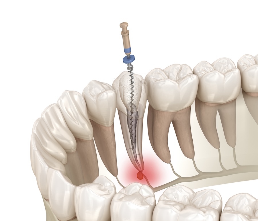 root canal treatment, root canal process, save your tooth, dentist in Petaluma, Alma Dental Care, dental infections, endodontic treatment, dental pain relief, tooth preservation