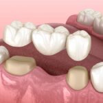 dental bridges, missing teeth, tooth replacement, Alma Dental Care, Petaluma dentist, restore smile, affordable tooth replacement, dentist in petaluma