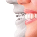 Invisalign, straighter smile, oral health, invisible aligners, clear braces, Petaluma dentist, orthodontic solutions