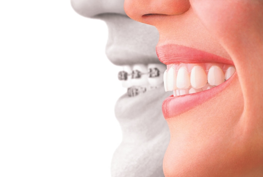 Invisalign, straighter smile, oral health, invisible aligners, clear braces, Petaluma dentist, orthodontic solutions