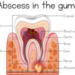 graphic of a tooth with an abscess in the gum needing root canal therapy