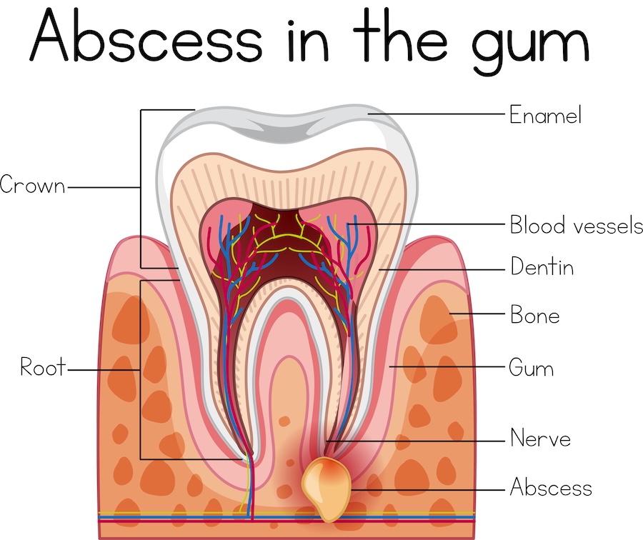 graphic of a tooth with an abscess in the gum needing root canal therapy