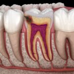 dental cavity on molar tooth, cavities, prone to cavities