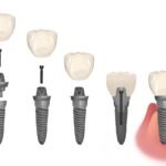parts of a dental implant, loos dental implant