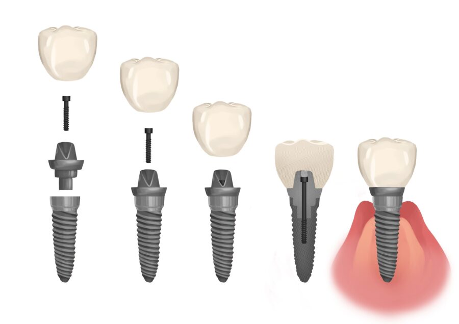 parts of a dental implant, loos dental implant