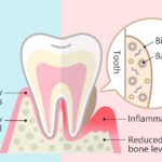 plaque biofilm on a tooth, healthy vs unhealthy