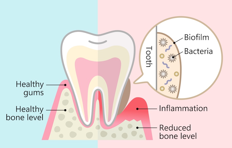 plaque biofilm on a tooth, healthy vs unhealthy