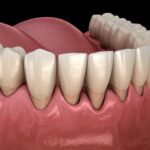 image of gum recession on mandibular teeth form gum disease or aggressive brushing