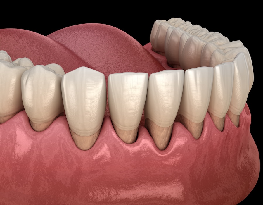 image of gum recession on mandibular teeth form gum disease or aggressive brushing