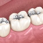silver fillings, amalgam fillings