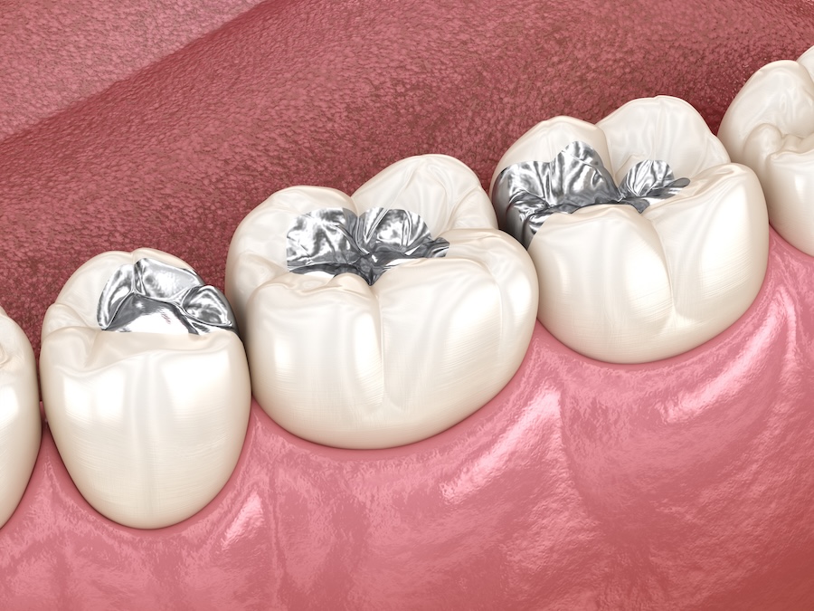 silver fillings, amalgam fillings