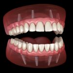 all-on-four dental implants