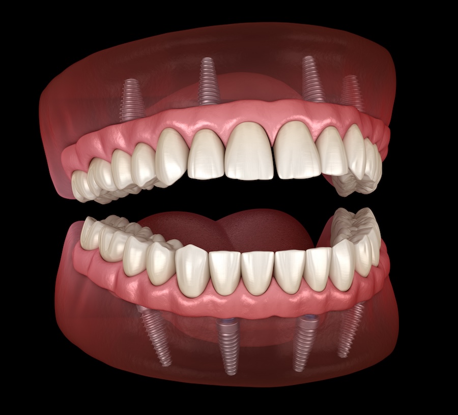 all-on-four dental implants