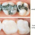 replacing metal fillings with composite fillings