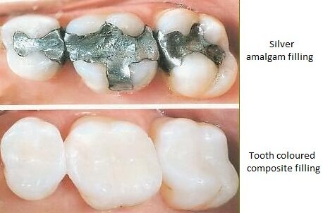 replacing metal fillings with composite fillings