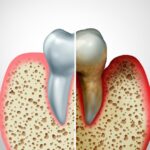 gum disease on a tooth needing periodontal therapy, deep cleaning