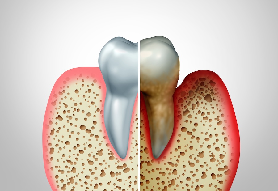 gum disease on a tooth needing periodontal therapy, deep cleaning