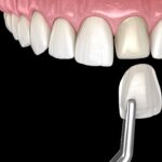 what if a veneer pops off, veneer installation and repair