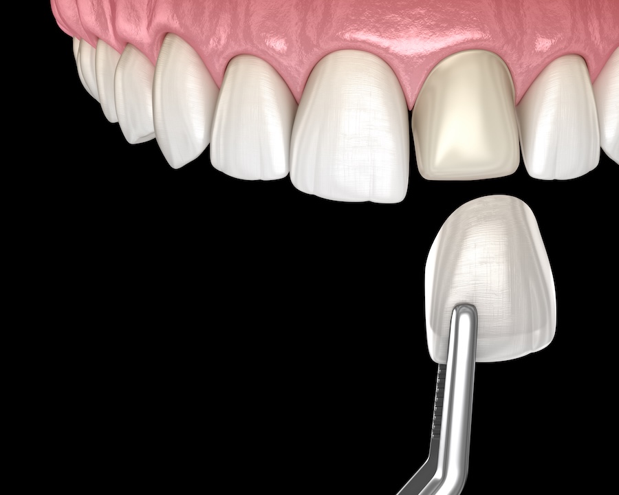 what if a veneer pops off, veneer installation and repair