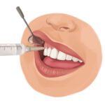 woman receiving local anesthesia for dental extraction at a dentist office