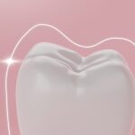 fluoride treatment